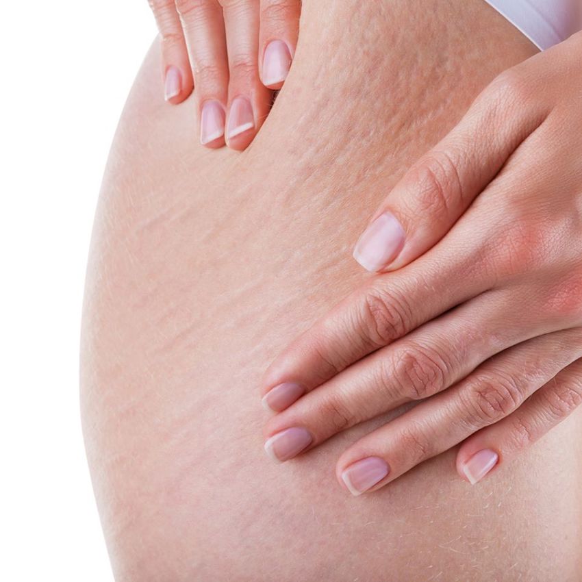 Health & Beauty - What Causes Stretch Marks and How to Treat Them - The Life of Stuff